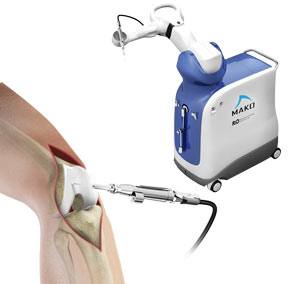Img- Robotic Assisted Partial Knee Replacement pic