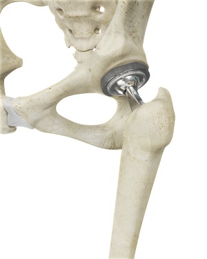 Image- Total Hip Replacement pic