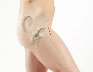 Anterior  Hip Replacement