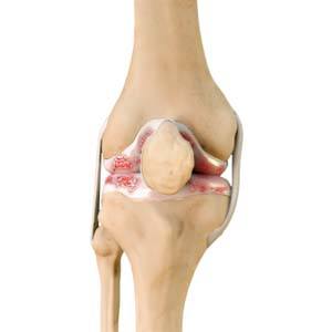 Knee Arthritis