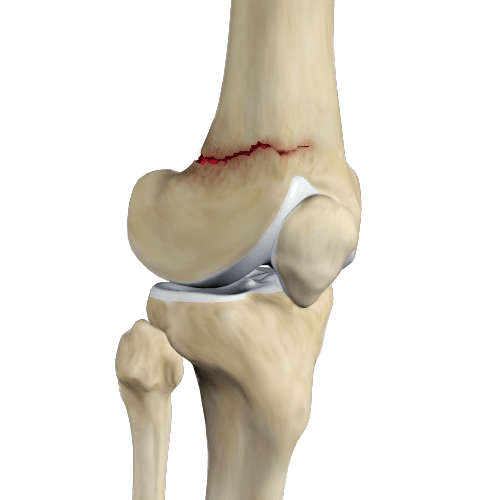 Knee Fracture