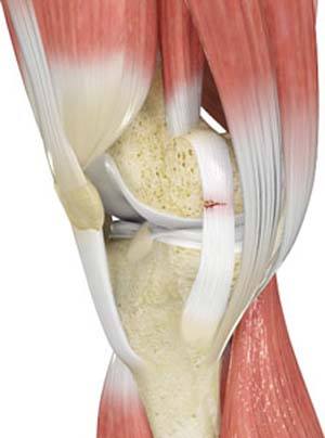 Ligament Injuries pic