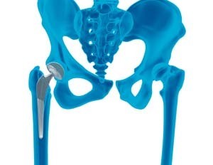 Outpatient Hip Surgery