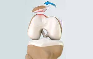 Patellofemoral Instability pic